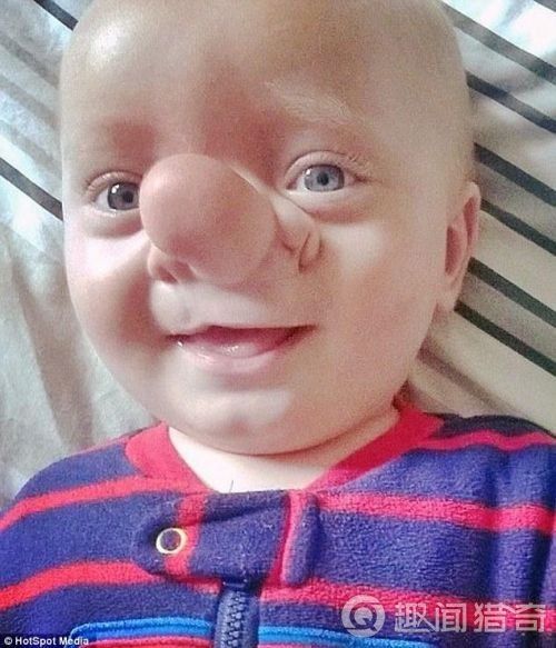 真的有个小男孩长了匹诺曹的大鼻子 但它是一种病